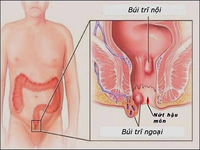các loại bệnh trĩ